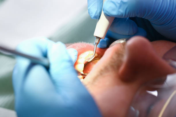 Best Emergency Root Canal Treatment in Stuarts Draft, VA